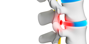 Präventionskurs §20. Bis zu 100% Cashback von Ihrer Krankenkasse. Schulter-Nacken-Stabilisation Kurs-ID:KU-BE-NJMQ1Q